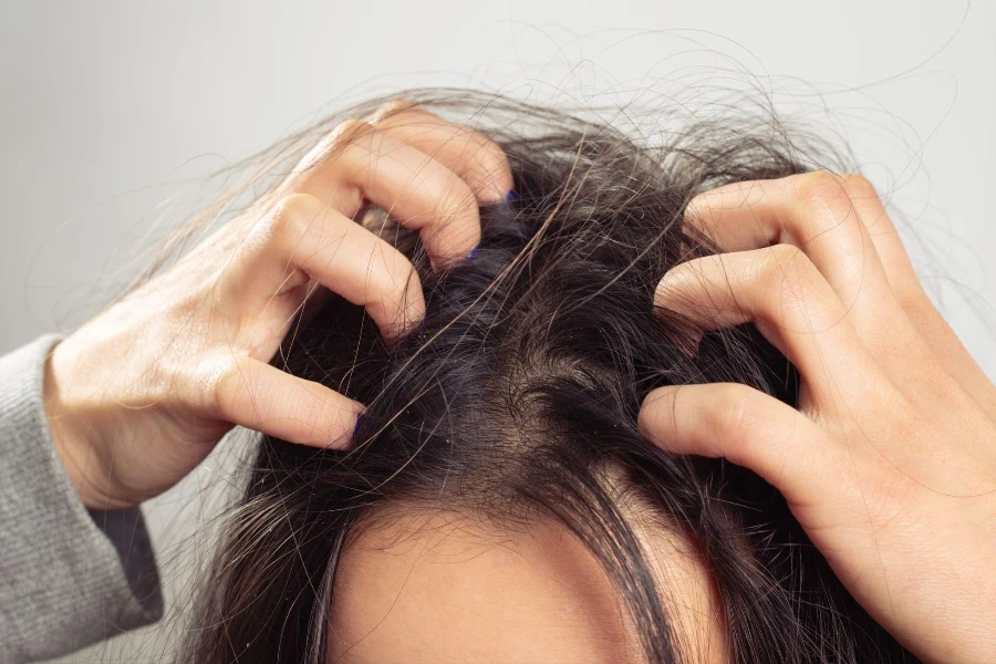 une jeune femme se gratte le cuir chevelu et les cheveux avec ses doigts