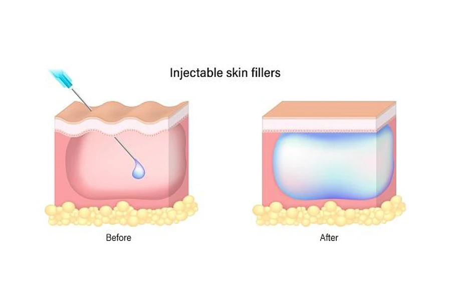 Injectable skin fillers