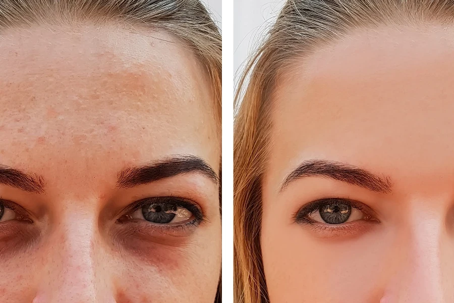 círculos pretos sob os olhos antes e depois