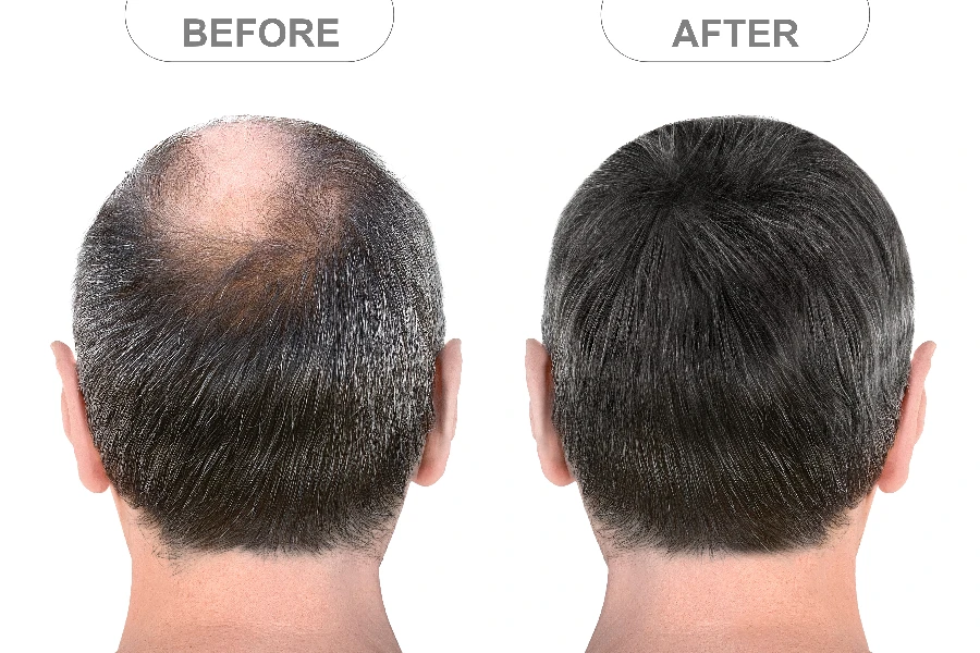 Vista traseira da cabeça masculina antes e depois das extensões de cabelo