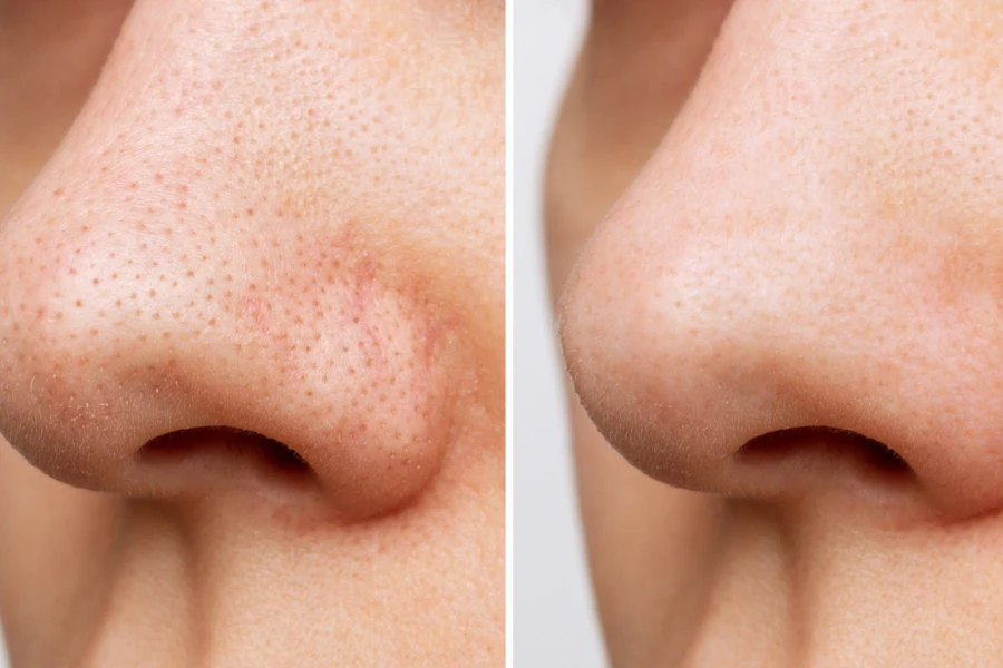 Close-up of woman's nose with blackheads or black dots before and after
