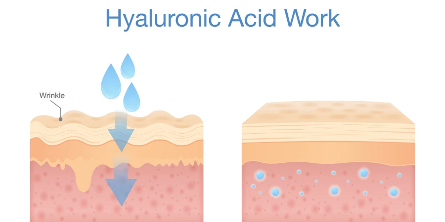ヒアルロン酸を皮膚層に取り入れることで肌の水分量が増加します