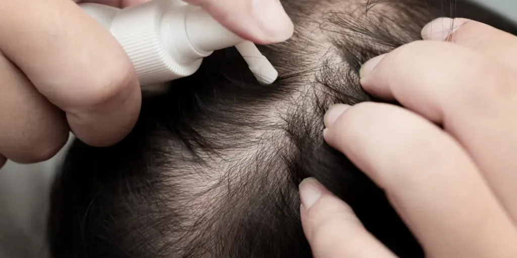 Close up of male’s hand using medication on scalp