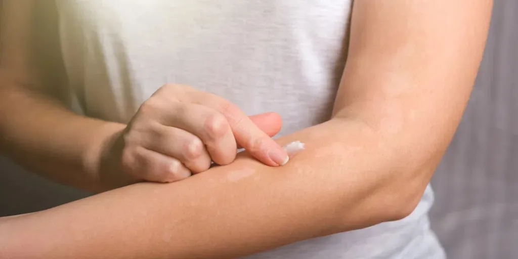 Young woman smears her hands with anti-itch dermatitis cream.