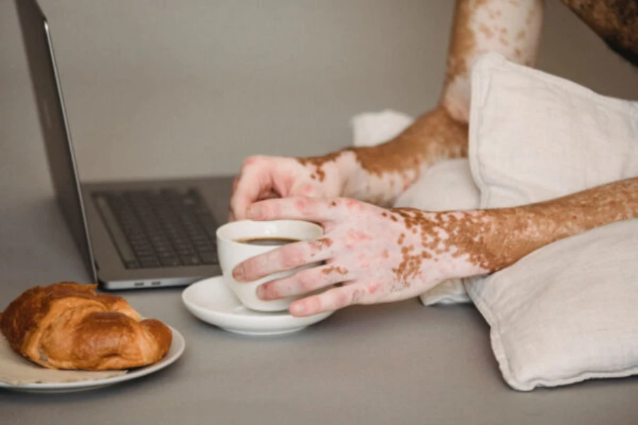 Elinde kahve kupası olan vitiligolu bir adamın kollarının yakın çekimi.