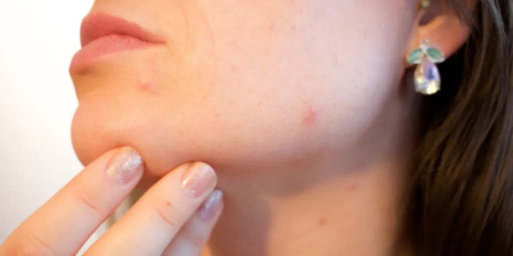 Close-up of woman’s face with acne