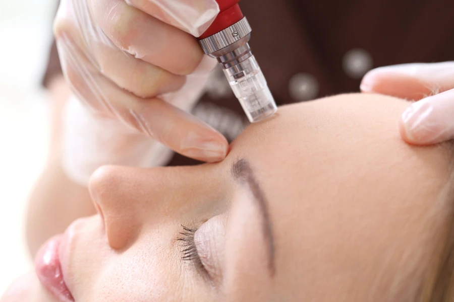 Woman receiving mesotherapy treatment on her forehead