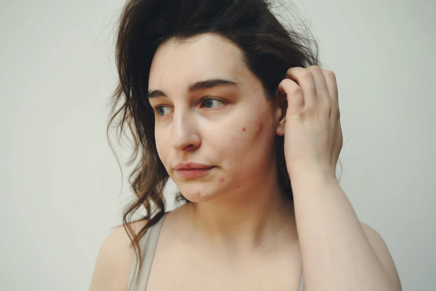 Femme avec une peau affectée par l'acné
