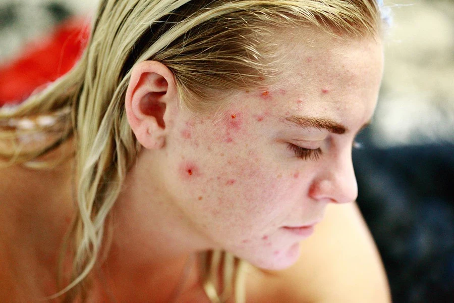 Lady with blackheads on her face