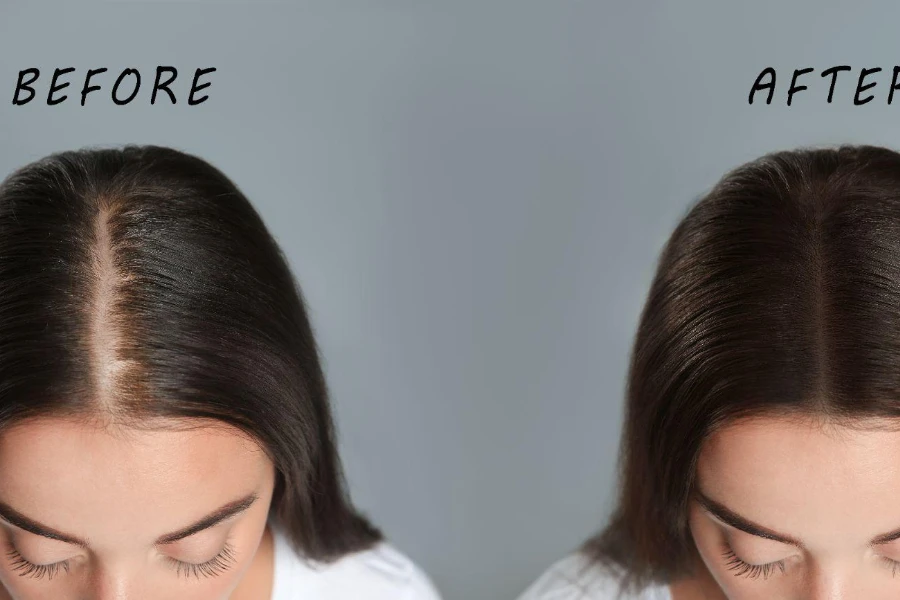 Mulher com problema de queda de cabelo antes e depois do tratamento em fundo cinza