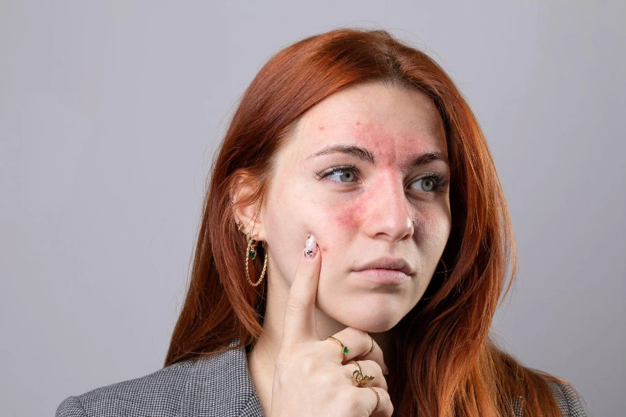 Symptoms of couperose with redness of the cheeks and nose