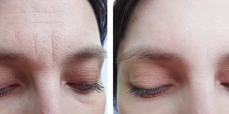 female forehead wrinkles before treatment