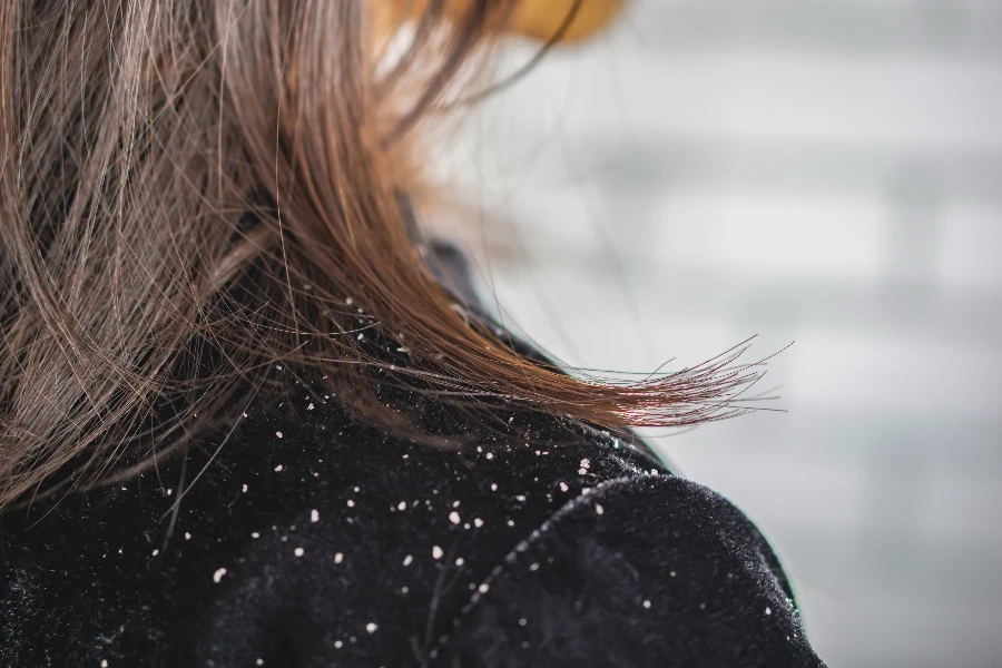 closeup woman hair with dandruff falling on shoulders
