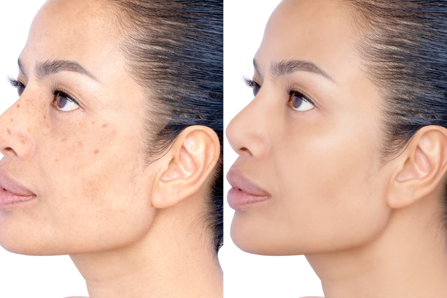 Before and after Healing removing Problem of facial Wrinkles
