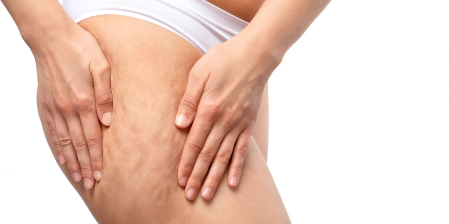The girl stretches the skin on her leg, showing fat deposits and cellulite