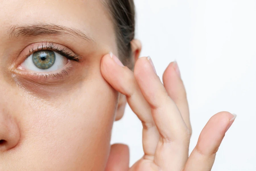 A young caucasian woman demonstrating dark circles under her eyes
