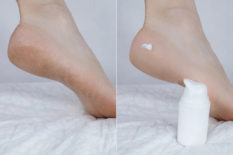 Woman feet before and after procedures to soften rough skin

