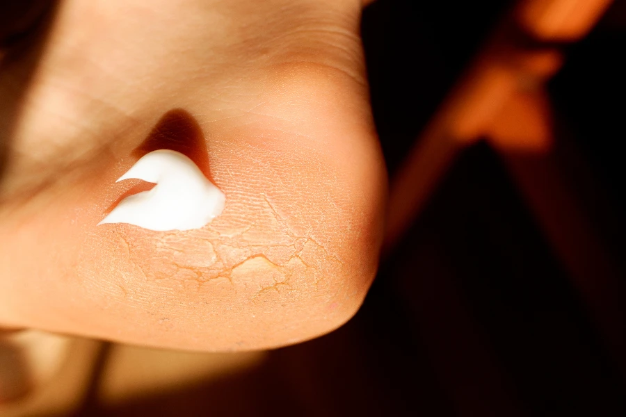 Cracked and dry skin on the heel of the foot treated with a cream rich in urea
