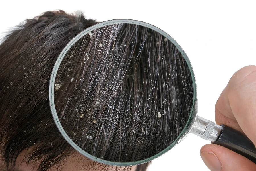 Examiming white dandruff flakes in hair with magnifying glass
