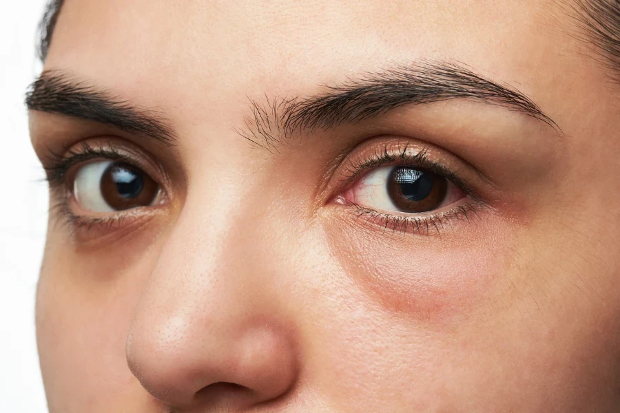 close up of young woman with red eye isolated on white
