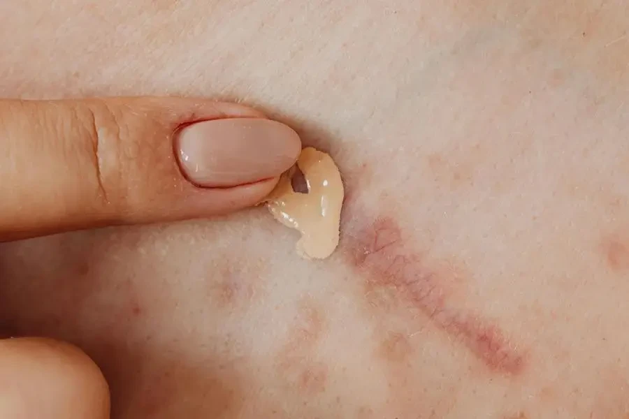 Covering a Scar with Concealer by Karolina Kaboompics