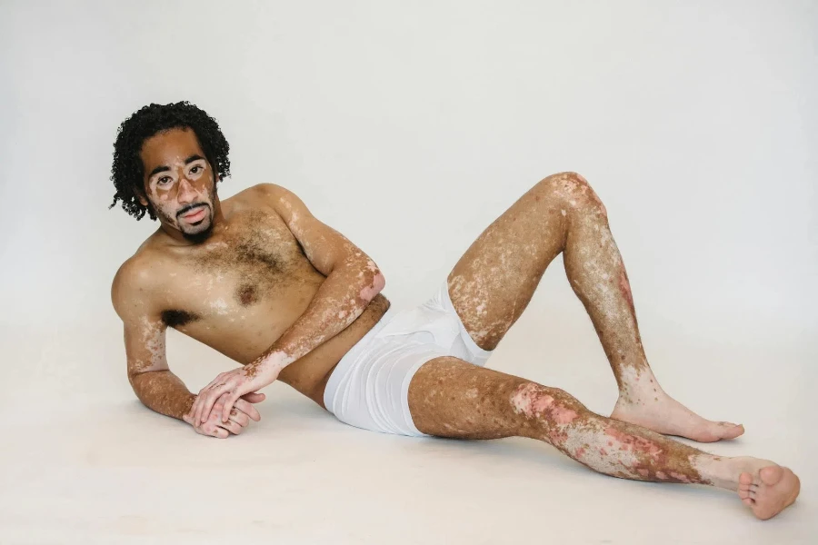 Young ethnic man with vitiligo in underwear