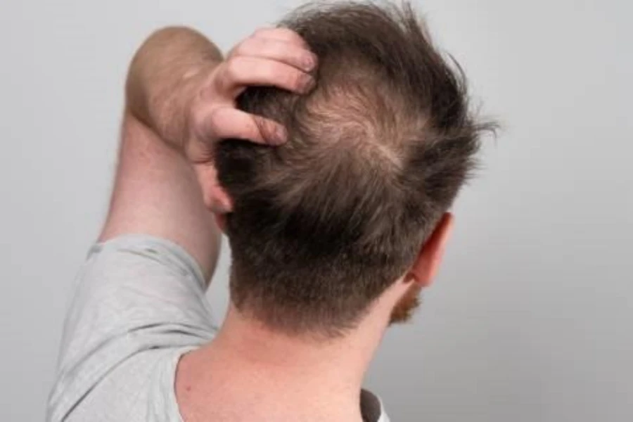 A balding man showing hair loss