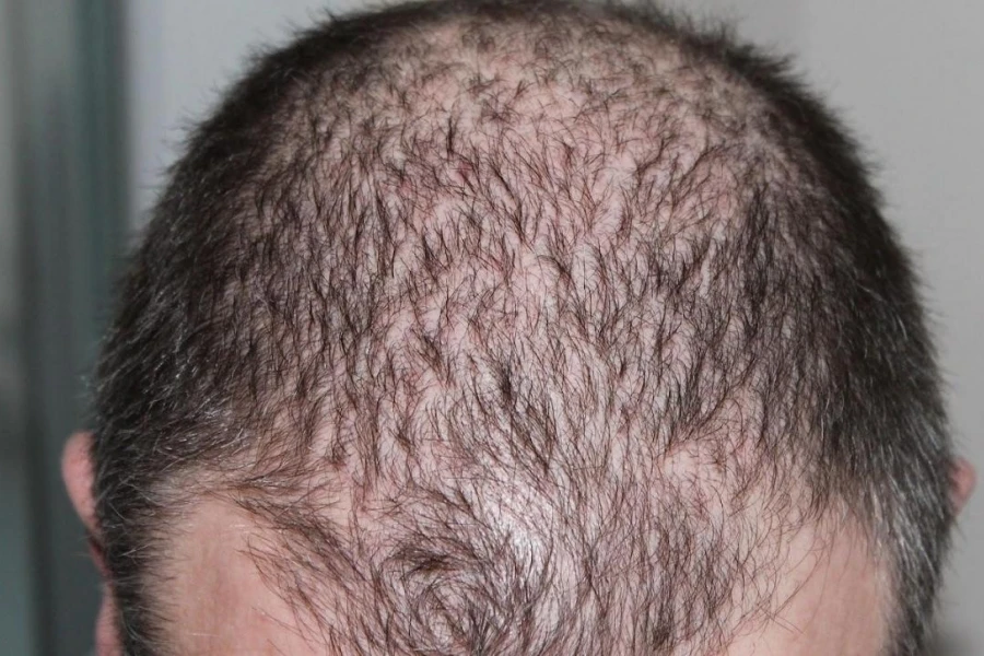 Man with severe hair loss