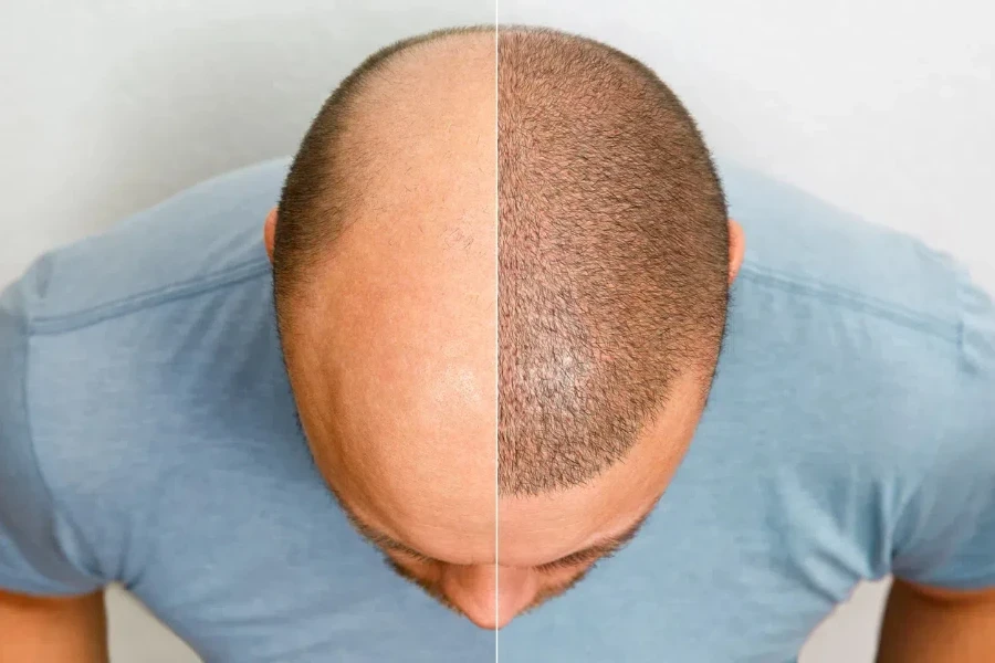 The before and after of a hair follicle transplant