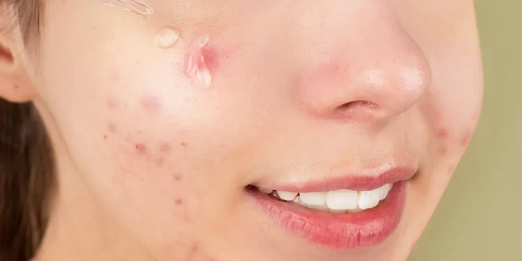 Close-up of a young woman applying serum on her face for acne treatment and skincare routine