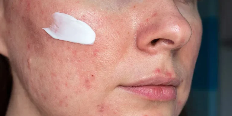 medicated ointment on woman face with rosacea close up