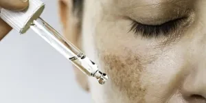 Woman treating hyperpigmentation with serum