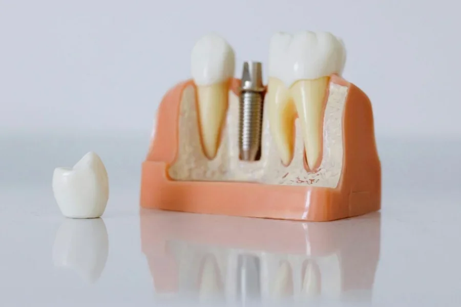 Close-Up Shot of Dental Implant Model